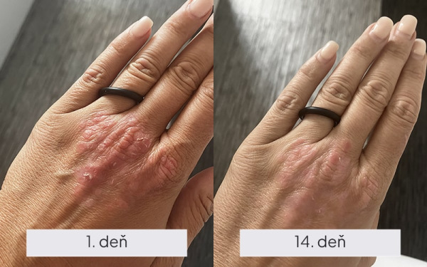 NAMYDERM - Dermal P – prírodný dermálny krém pre psoriázu a suchý ekzém – 50 ml 2