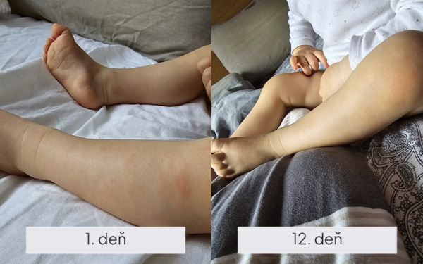 NAMYDERM - Dermal B – dermálny krém na atopický ekzém, psoriázu a suché ekzémy – 50 ml 1