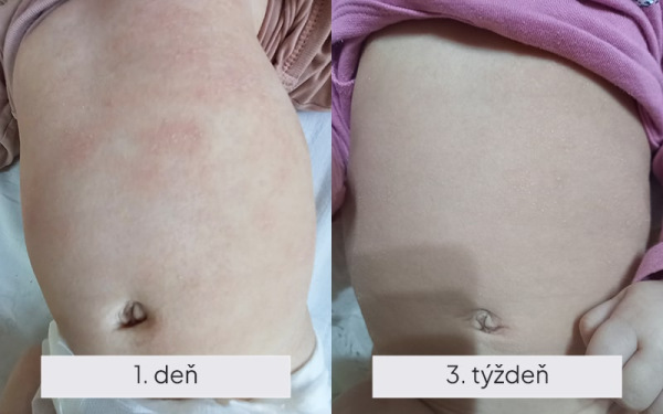 NAMYDERM - Dermal B – dermálny krém na atopický ekzém, psoriázu a suché ekzémy – 50 ml 2