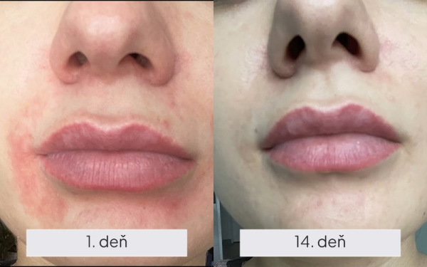 NAMYDERM - Dermal C – prírodný dermálny krém na mokvajúci ekzém, akné, lichen – 50 ml 1