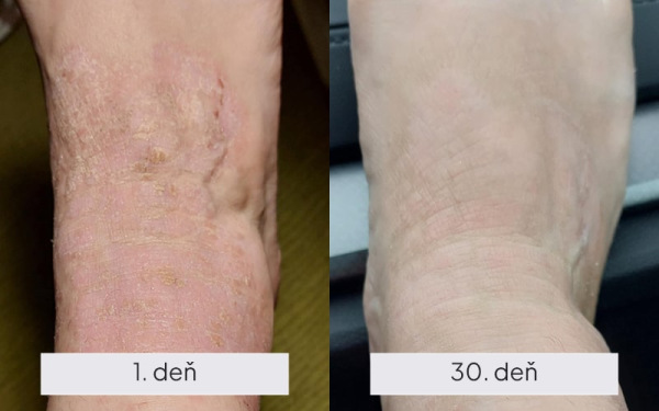 NAMYDERM - Dermal R – prírodný dermálny krém na popraskanú a extrémne suchú pokožku– 50 ml 2