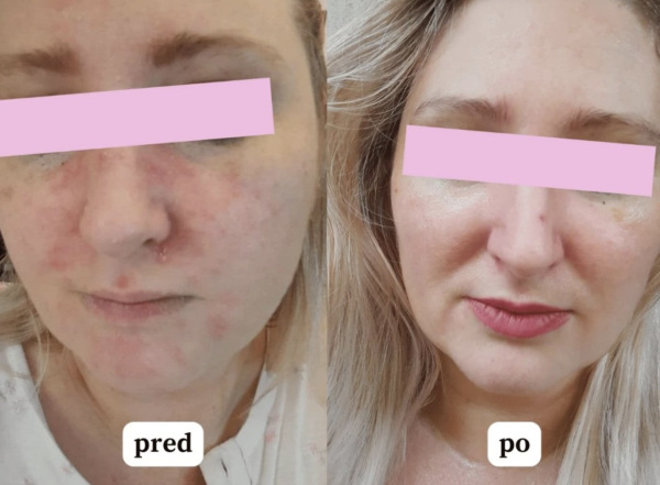 Barbora Lori - Ochranný denný krém pre suchú aj zrelšiu pleť - s liftingovým účinkom - 50g 2