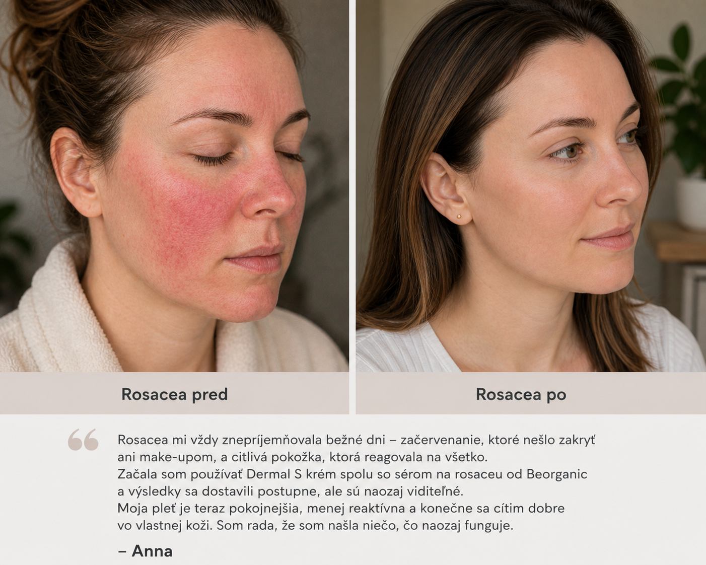 Rosacea